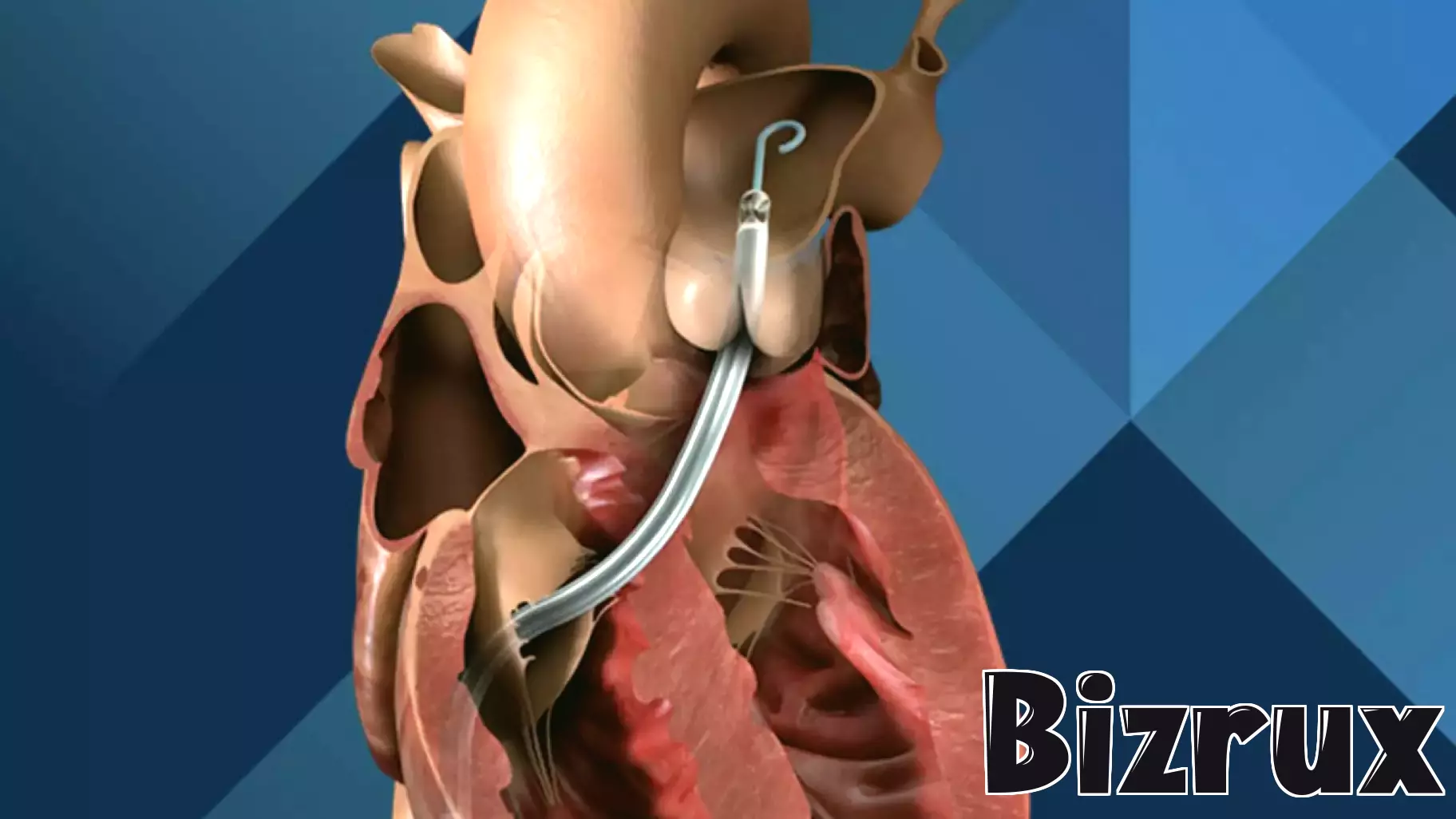 FDA warns that Johnson & Johnson heart pump sensors may malfunction—22 injuries reported